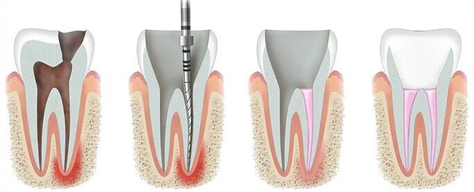 Etapy leczenia kanałowego pod mikroskopem