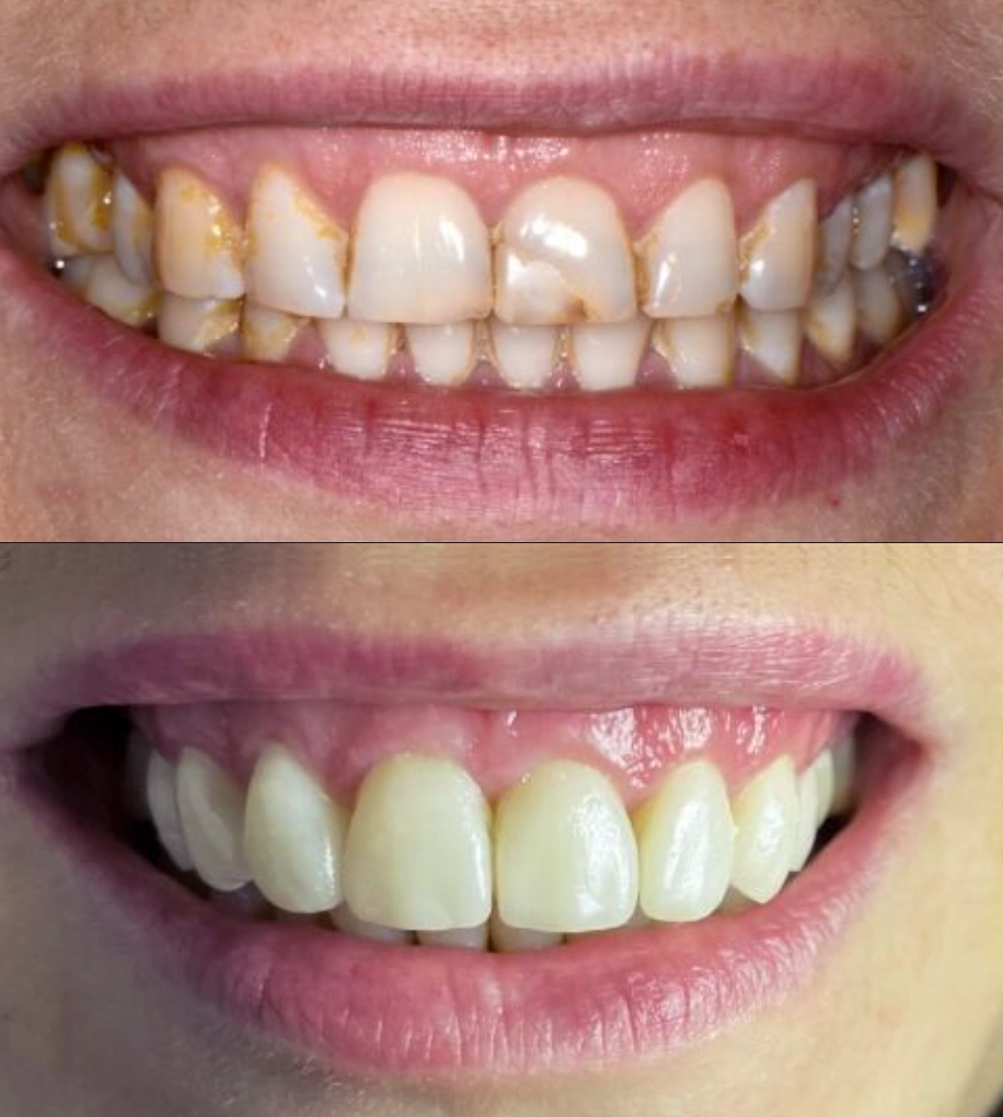 licówki Poznań przed i po