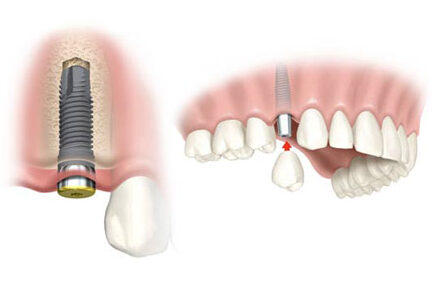 implanty zębowe poznań - co to jest implant